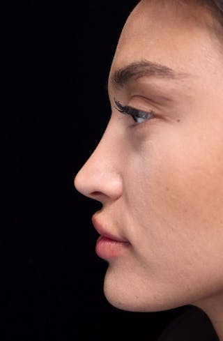 Beverly Hills Rhinoplasty Before & After Gallery - Patient 324304 - Image 14 Dr. Deepak Raj Dugar