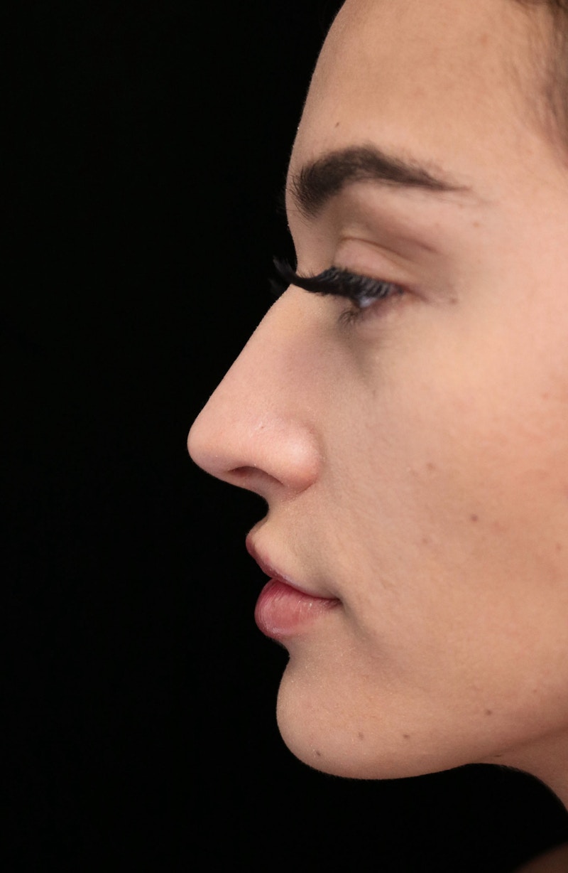 Beverly Hills Rhinoplasty Before & After Gallery - Patient 324304 - Image 13 Dr. Deepak Raj Dugar