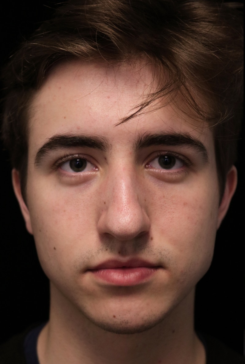 Beverly Hills Rhinoplasty Before & After Gallery - Patient 198423 - Image 3 Dr. Deepak Raj Dugar