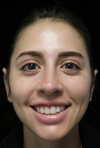 Beverly Hills Rhinoplasty Before & After Gallery - Patient 340500 - Image 4 Dr. Deepak Raj Dugar