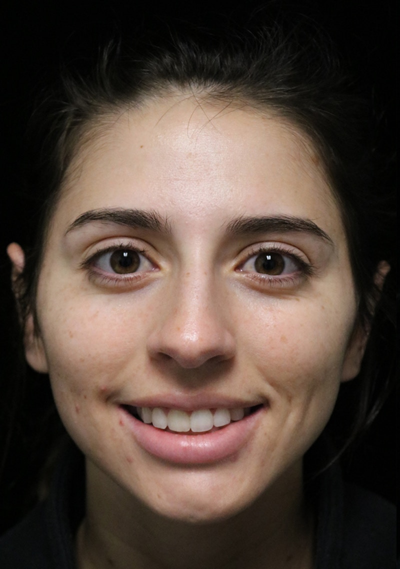 Beverly Hills Rhinoplasty Before & After Gallery - Patient 340500 - Image 3 Dr. Deepak Raj Dugar