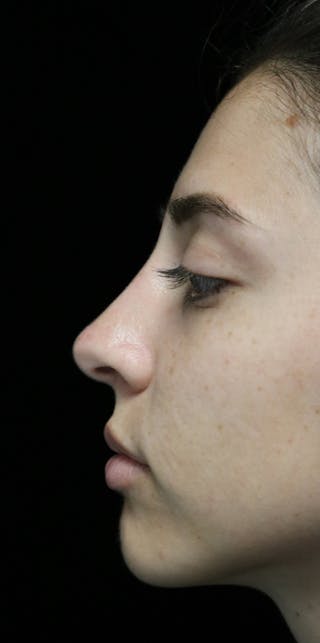 Beverly Hills Rhinoplasty Before & After Gallery - Patient 340500 - Image 6 Dr. Deepak Raj Dugar