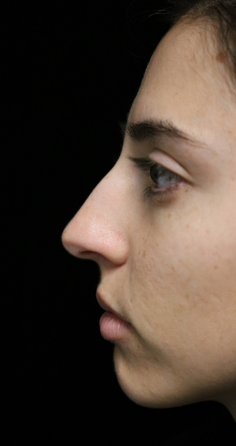 Beverly Hills Rhinoplasty Before & After Gallery - Patient 340500 - Image 5 Dr. Deepak Raj Dugar