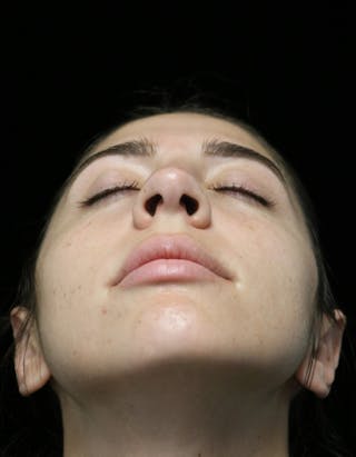 Beverly Hills Rhinoplasty Before & After Gallery - Patient 340500 - Image 8 Dr. Deepak Raj Dugar