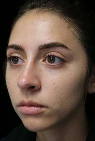 Beverly Hills Rhinoplasty Before & After Gallery - Patient 340500 - Image 10 Dr. Deepak Raj Dugar