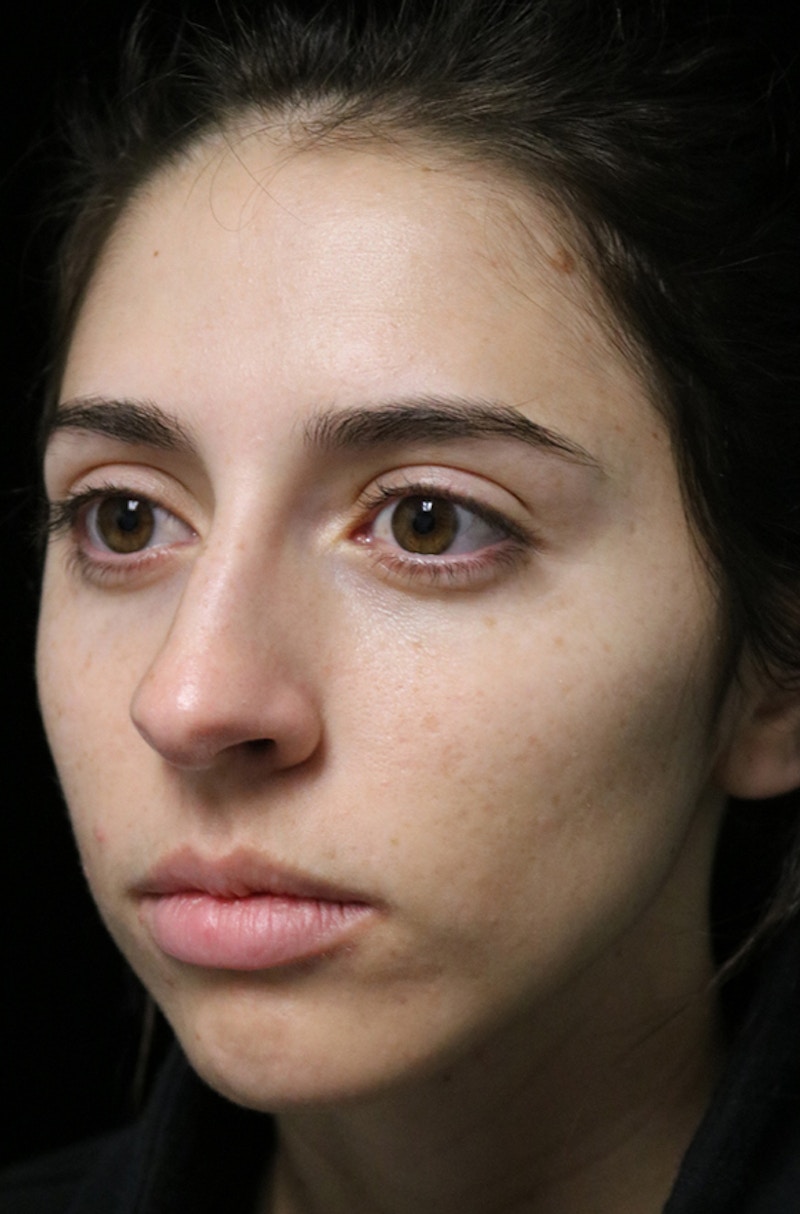 Beverly Hills Rhinoplasty Before & After Gallery - Patient 340500 - Image 9 Dr. Deepak Raj Dugar