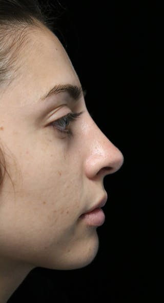 Beverly Hills Rhinoplasty Before & After Gallery - Patient 340500 - Image 2 Dr. Deepak Raj Dugar