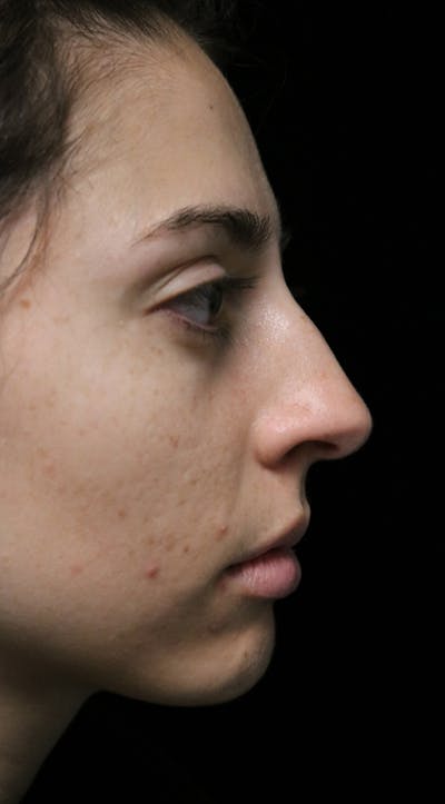 Beverly Hills Rhinoplasty Before & After Gallery - Patient 340500 - Image 1 Dr. Deepak Raj Dugar