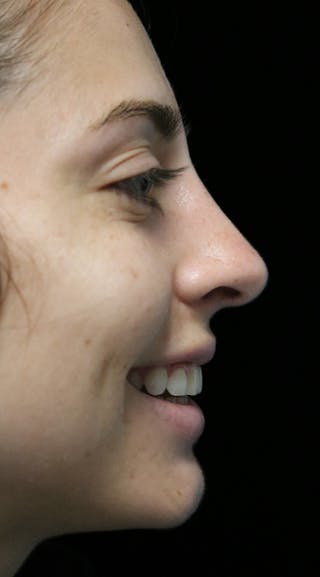 Beverly Hills Rhinoplasty Before & After Gallery - Patient 340500 - Image 12 Dr. Deepak Raj Dugar