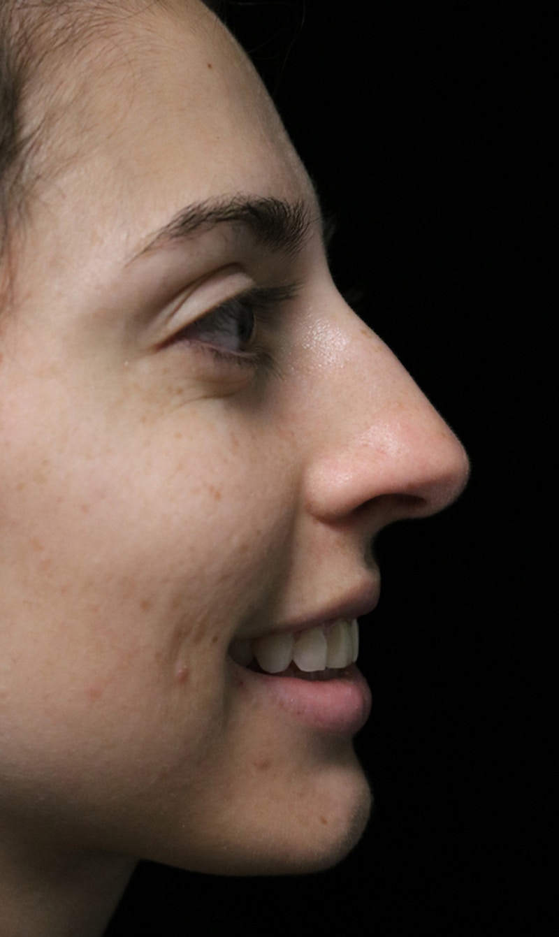 Beverly Hills Rhinoplasty Before & After Gallery - Patient 340500 - Image 11 Dr. Deepak Raj Dugar