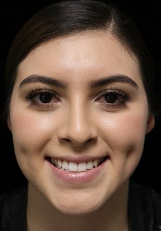 Beverly Hills Rhinoplasty Before & After Gallery - Patient 173138 - Image 4 Dr. Deepak Raj Dugar