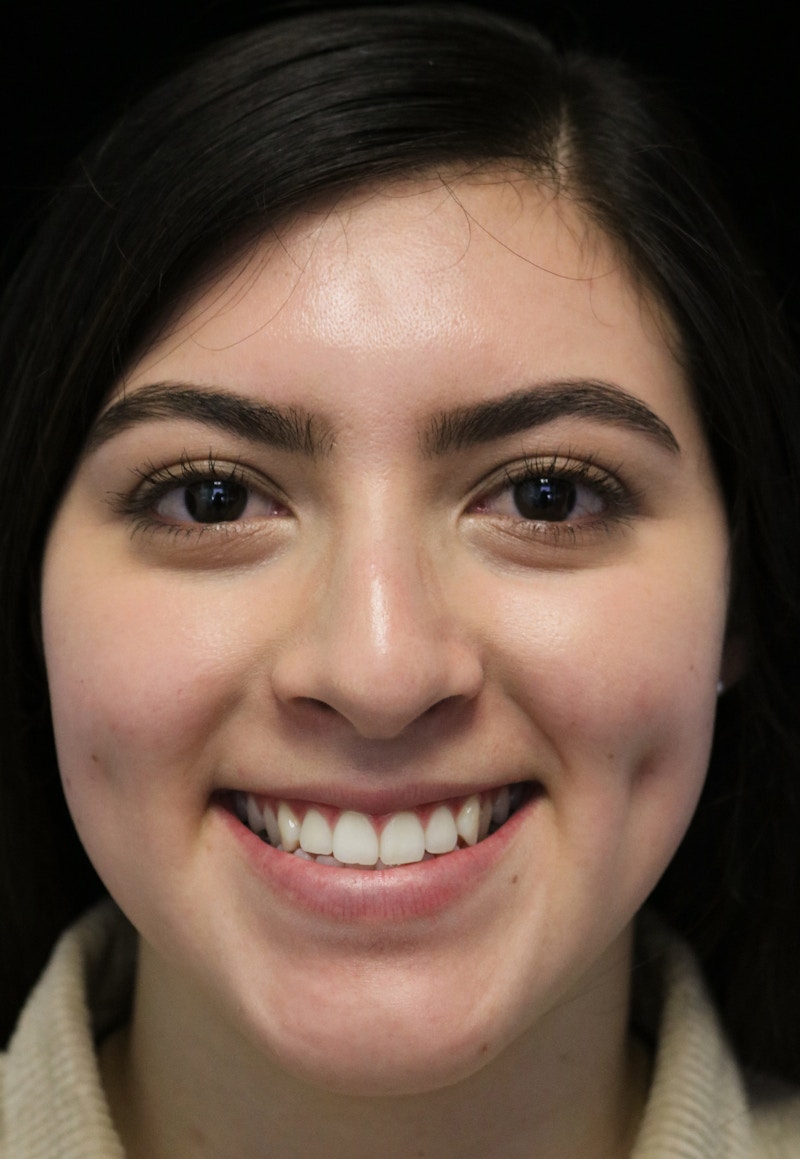 Beverly Hills Rhinoplasty Before & After Gallery - Patient 173138 - Image 3 Dr. Deepak Raj Dugar