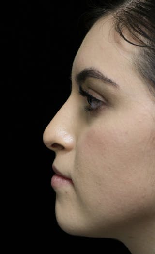 Beverly Hills Rhinoplasty Before & After Gallery - Patient 173138 - Image 6 Dr. Deepak Raj Dugar