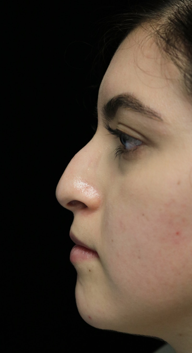 Beverly Hills Rhinoplasty Before & After Gallery - Patient 173138 - Image 5 Dr. Deepak Raj Dugar
