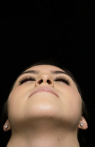 Beverly Hills Rhinoplasty Before & After Gallery - Patient 173138 - Image 8 Dr. Deepak Raj Dugar