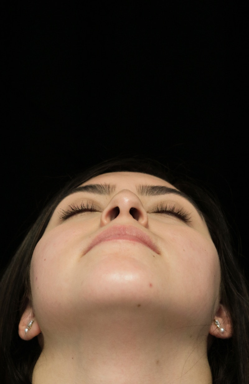 Beverly Hills Rhinoplasty Before & After Gallery - Patient 173138 - Image 7 Dr. Deepak Raj Dugar