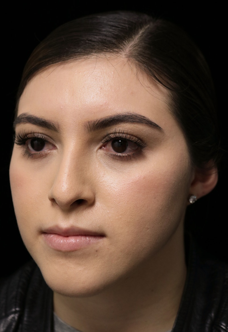 Beverly Hills Rhinoplasty Before & After Gallery - Patient 173138 - Image 10 Dr. Deepak Raj Dugar