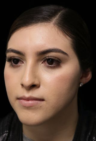 Beverly Hills Rhinoplasty Before & After Gallery - Patient 173138 - Image 10 Dr. Deepak Raj Dugar