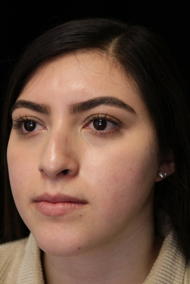 Beverly Hills Rhinoplasty Before & After Gallery - Patient 173138 - Image 9 Dr. Deepak Raj Dugar