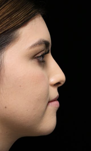 Beverly Hills Rhinoplasty Before & After Gallery - Patient 173138 - Image 2 Dr. Deepak Raj Dugar