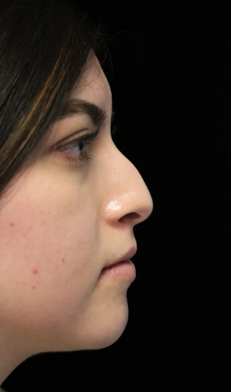 Beverly Hills Rhinoplasty Before & After Gallery - Patient 173138 - Image 1 Dr. Deepak Raj Dugar