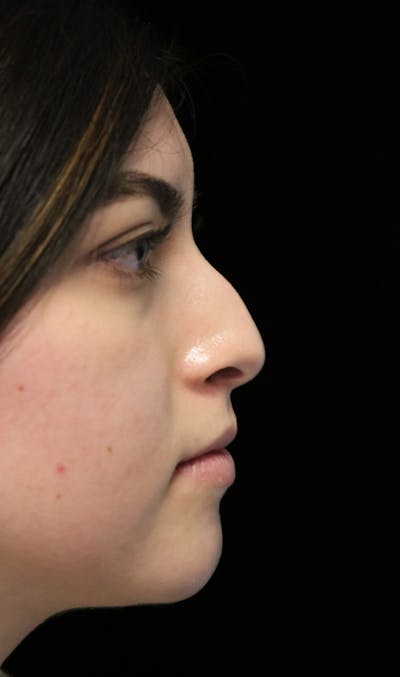 Beverly Hills Rhinoplasty Before & After Gallery - Patient 173138 - Image 1 Dr. Deepak Raj Dugar