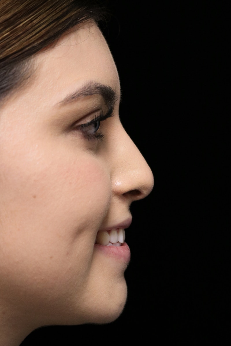 Beverly Hills Rhinoplasty Before & After Gallery - Patient 173138 - Image 12 Dr. Deepak Raj Dugar