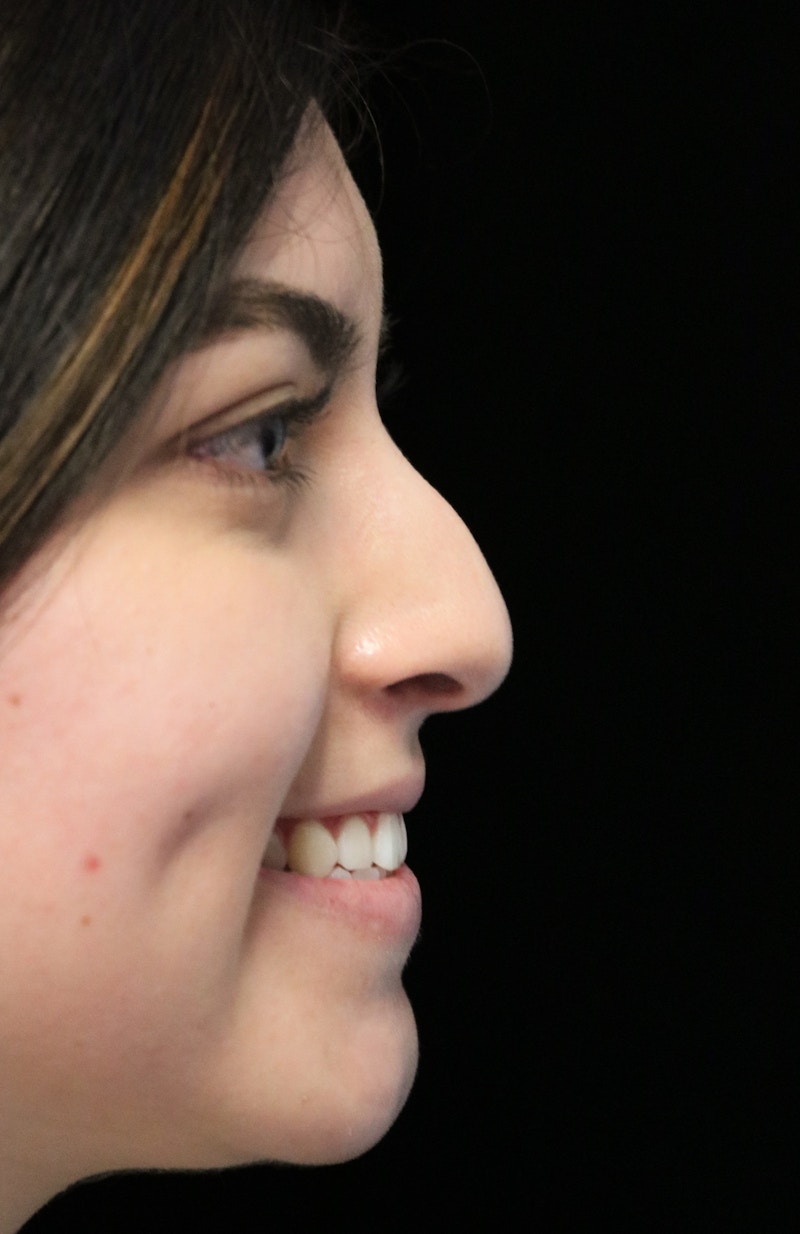 Beverly Hills Rhinoplasty Before & After Gallery - Patient 173138 - Image 11 Dr. Deepak Raj Dugar