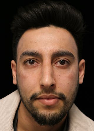 Beverly Hills Rhinoplasty Before & After Gallery - Patient 711022 - Image 4 Dr. Deepak Raj Dugar