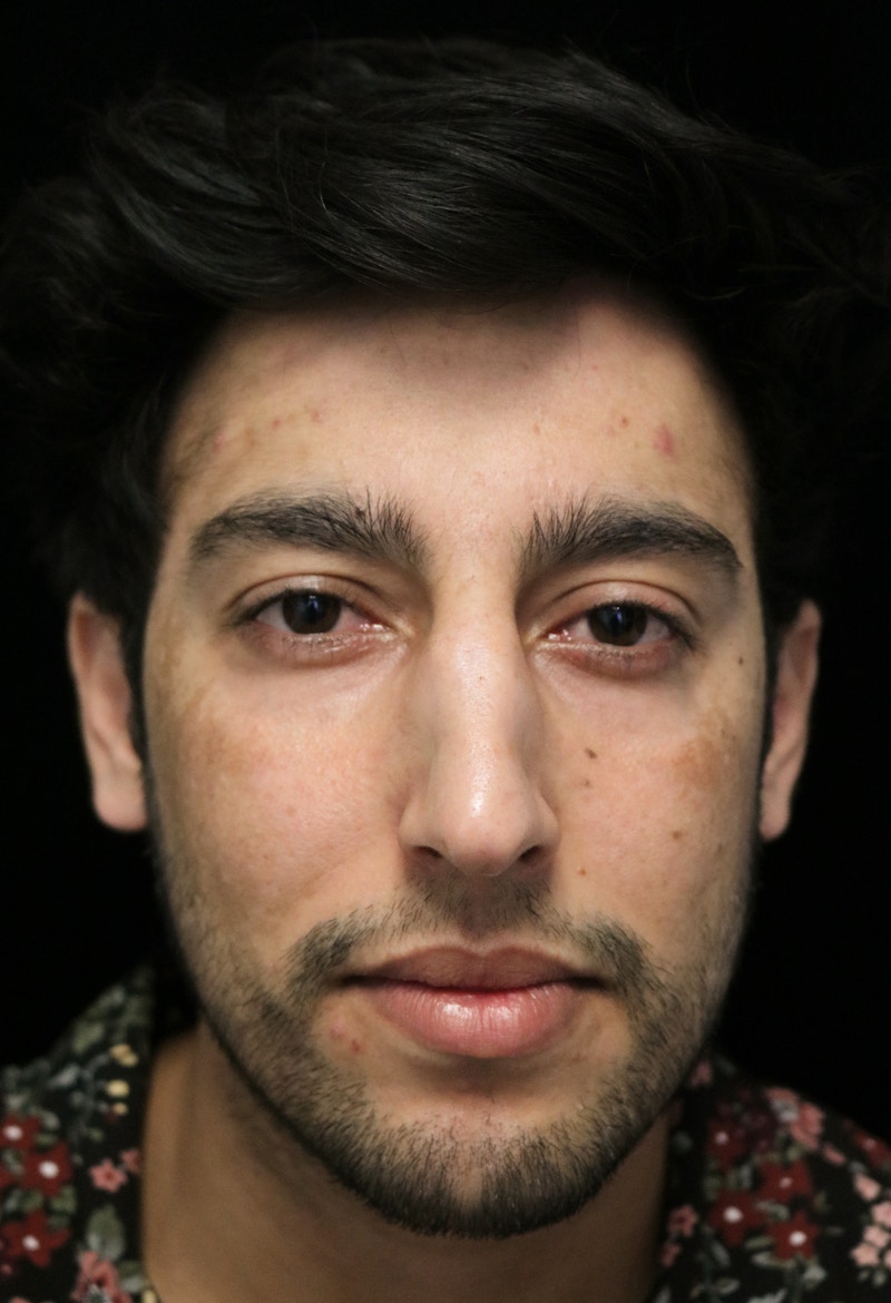 Beverly Hills Rhinoplasty Before & After Gallery - Patient 711022 - Image 3 Dr. Deepak Raj Dugar