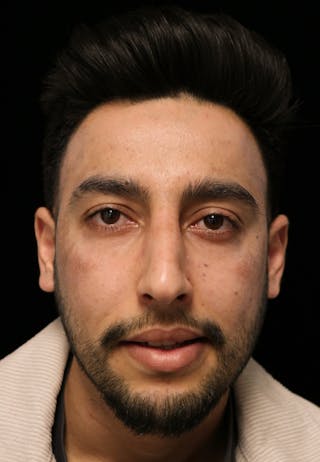 Beverly Hills Rhinoplasty Before & After Gallery - Patient 711022 - Image 6 Dr. Deepak Raj Dugar