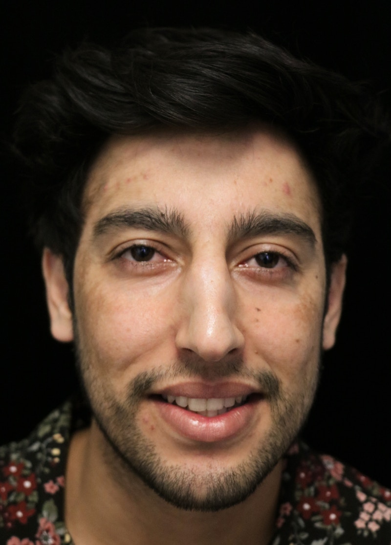Beverly Hills Rhinoplasty Before & After Gallery - Patient 711022 - Image 5 Dr. Deepak Raj Dugar