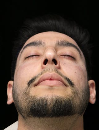 Beverly Hills Rhinoplasty Before & After Gallery - Patient 711022 - Image 8 Dr. Deepak Raj Dugar