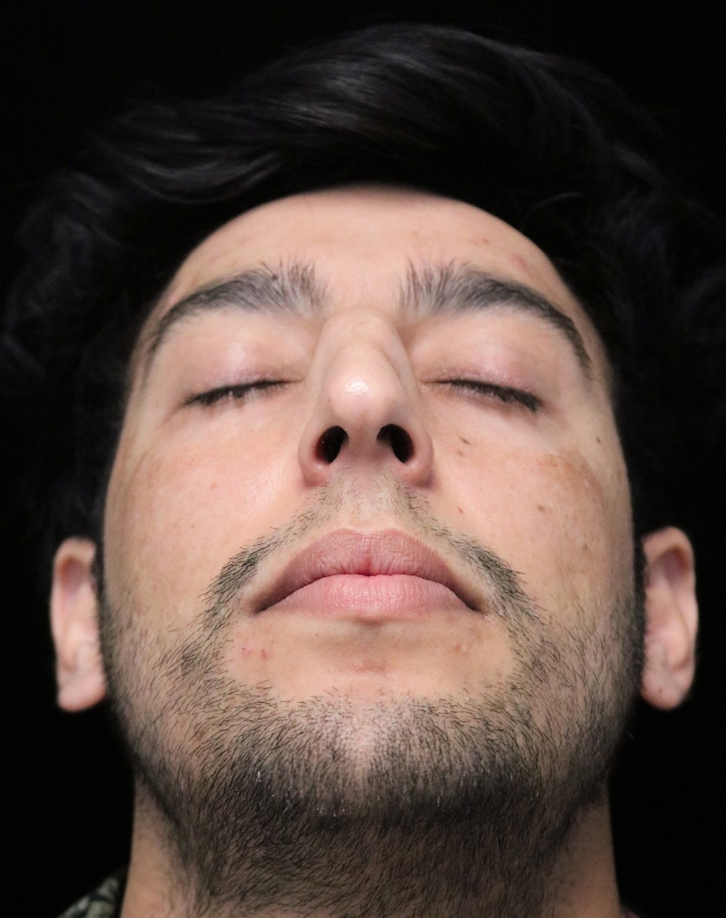 Beverly Hills Rhinoplasty Before & After Gallery - Patient 711022 - Image 7 Dr. Deepak Raj Dugar
