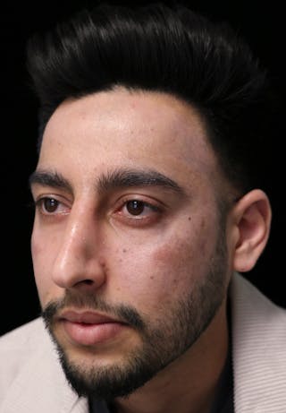 Beverly Hills Rhinoplasty Before & After Gallery - Patient 711022 - Image 10 Dr. Deepak Raj Dugar