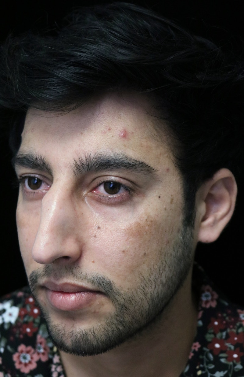 Beverly Hills Rhinoplasty Before & After Gallery - Patient 711022 - Image 9 Dr. Deepak Raj Dugar