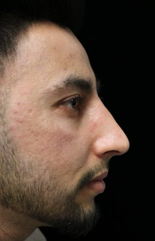 Beverly Hills Rhinoplasty Before & After Gallery - Patient 711022 - Image 2 Dr. Deepak Raj Dugar