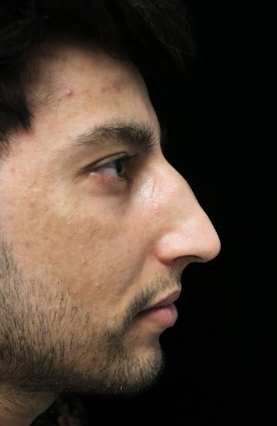 Beverly Hills Rhinoplasty Before & After Gallery - Patient 711022 - Image 1 Dr. Deepak Raj Dugar