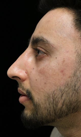 Beverly Hills Rhinoplasty Before & After Gallery - Patient 711022 - Image 12 Dr. Deepak Raj Dugar
