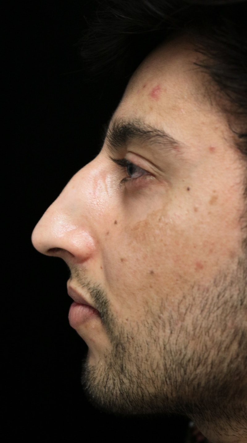 Beverly Hills Rhinoplasty Before & After Gallery - Patient 711022 - Image 11 Dr. Deepak Raj Dugar