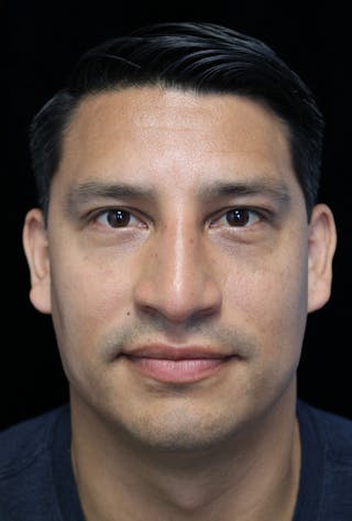 Beverly Hills Rhinoplasty Before & After Gallery - Patient 341503 - Image 4 Dr. Deepak Raj Dugar