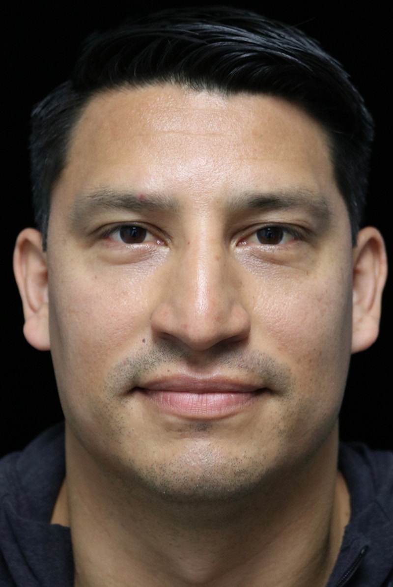 Beverly Hills Rhinoplasty Before & After Gallery - Patient 341503 - Image 3 Dr. Deepak Raj Dugar