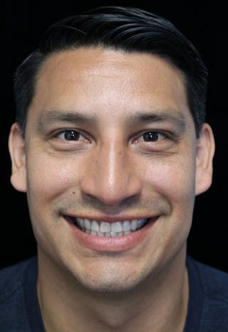 Beverly Hills Rhinoplasty Before & After Gallery - Patient 341503 - Image 6 Dr. Deepak Raj Dugar