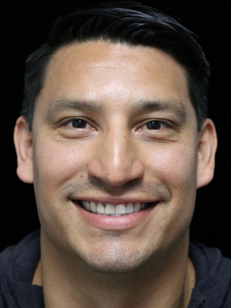 Beverly Hills Rhinoplasty Before & After Gallery - Patient 341503 - Image 5 Dr. Deepak Raj Dugar