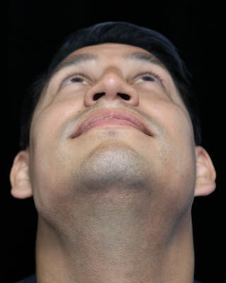 Beverly Hills Rhinoplasty Before & After Gallery - Patient 341503 - Image 8 Dr. Deepak Raj Dugar