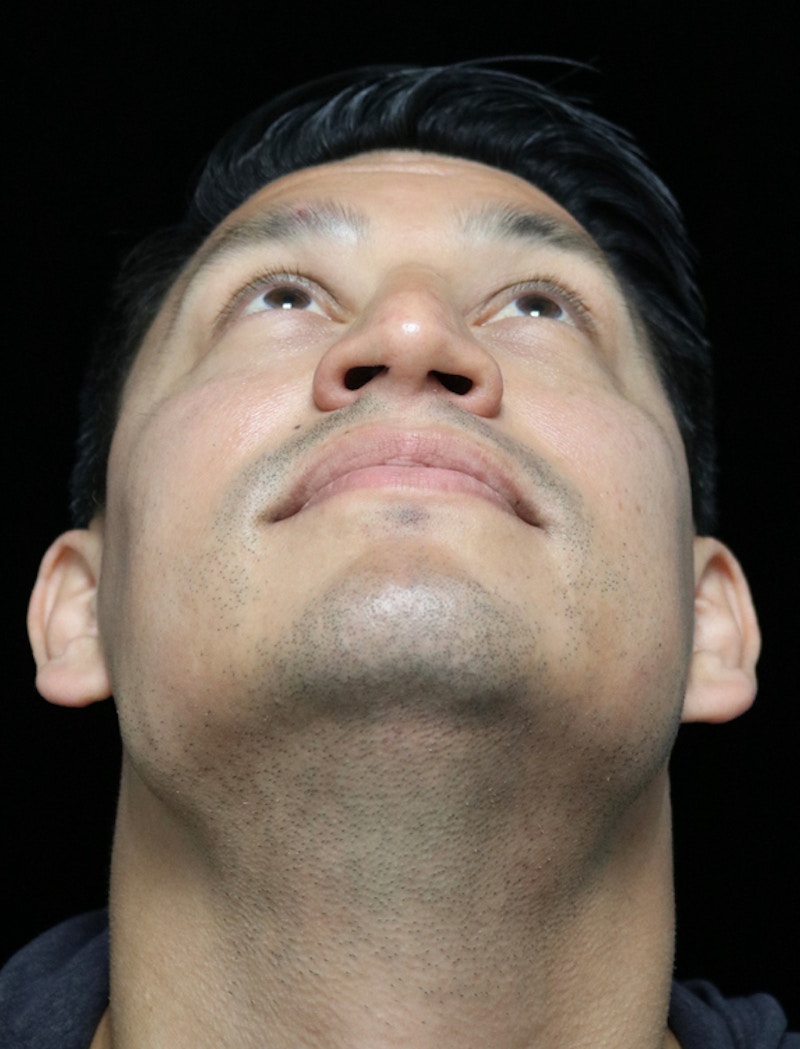 Beverly Hills Rhinoplasty Before & After Gallery - Patient 341503 - Image 7 Dr. Deepak Raj Dugar