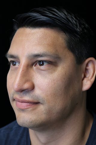 Beverly Hills Rhinoplasty Before & After Gallery - Patient 341503 - Image 10 Dr. Deepak Raj Dugar