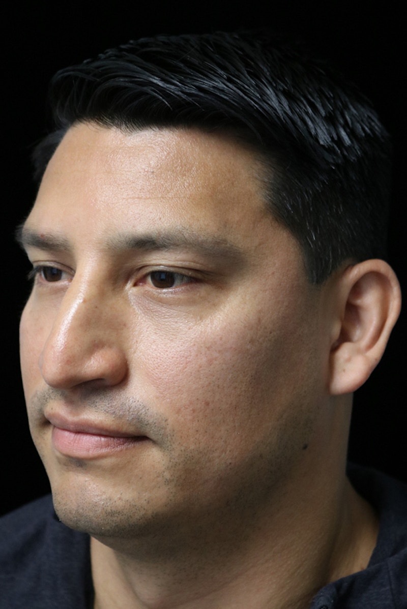 Beverly Hills Rhinoplasty Before & After Gallery - Patient 341503 - Image 9 Dr. Deepak Raj Dugar