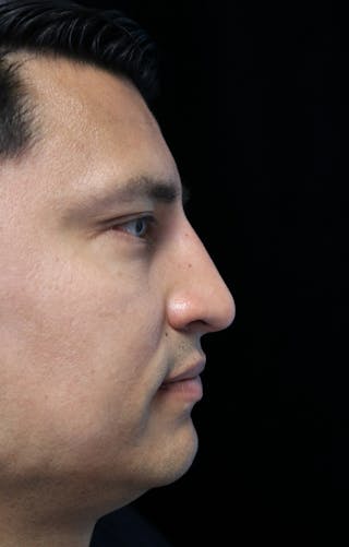Beverly Hills Rhinoplasty Before & After Gallery - Patient 341503 - Image 2 Dr. Deepak Raj Dugar