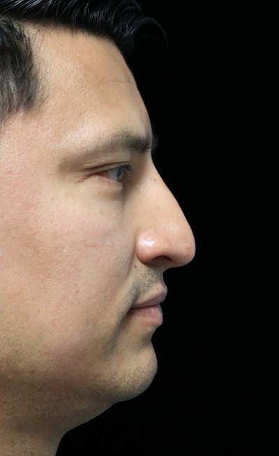 Beverly Hills Rhinoplasty Before & After Gallery - Patient 341503 - Image 1 Dr. Deepak Raj Dugar